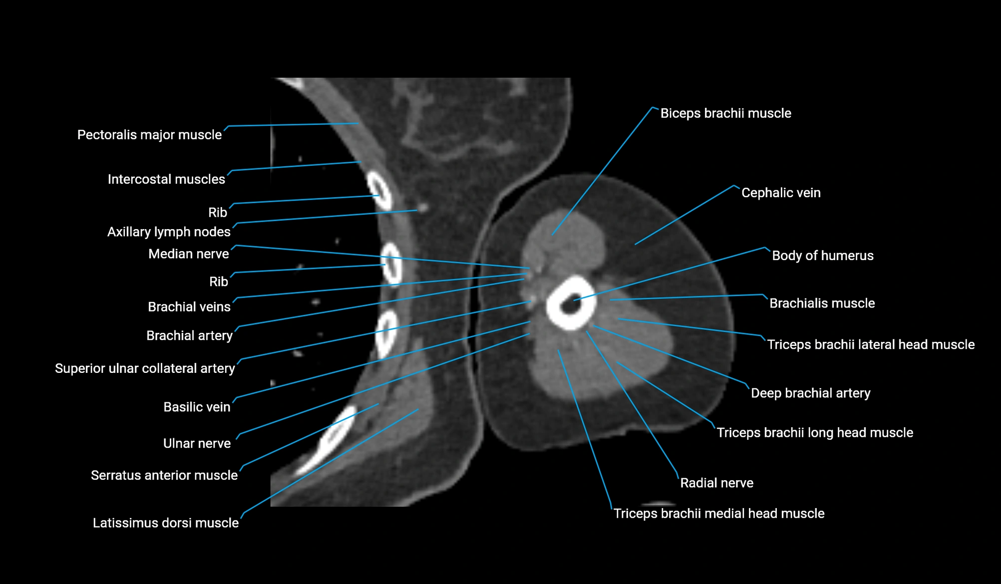 CT upper arm axial  cross sectional anatomy labelled radiology image -00234.webp